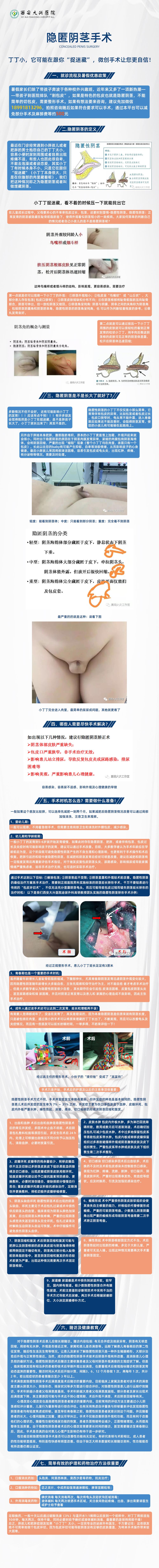 隐匿阴茎手术服务卡详细.jpg